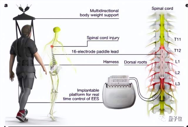 电刺激让瘫痪者重新行走原理找到了，3人已治疗成功 | Nature