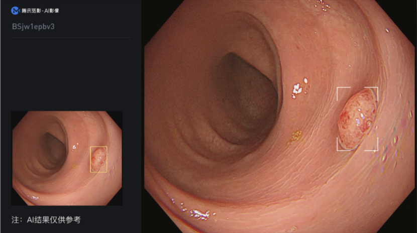 腾讯觅影结肠AI获批上市，有助于结肠癌早发现