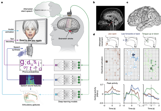 AI脑机接口让瘫痪人士重拾语言能力，UCSF华人科学家主导
